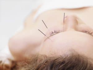 Is acupuncture becoming more popular?